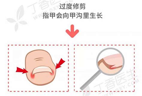 小拇指 指甲|指甲剪不对，带来大麻烦！正确剪指甲应该这样。